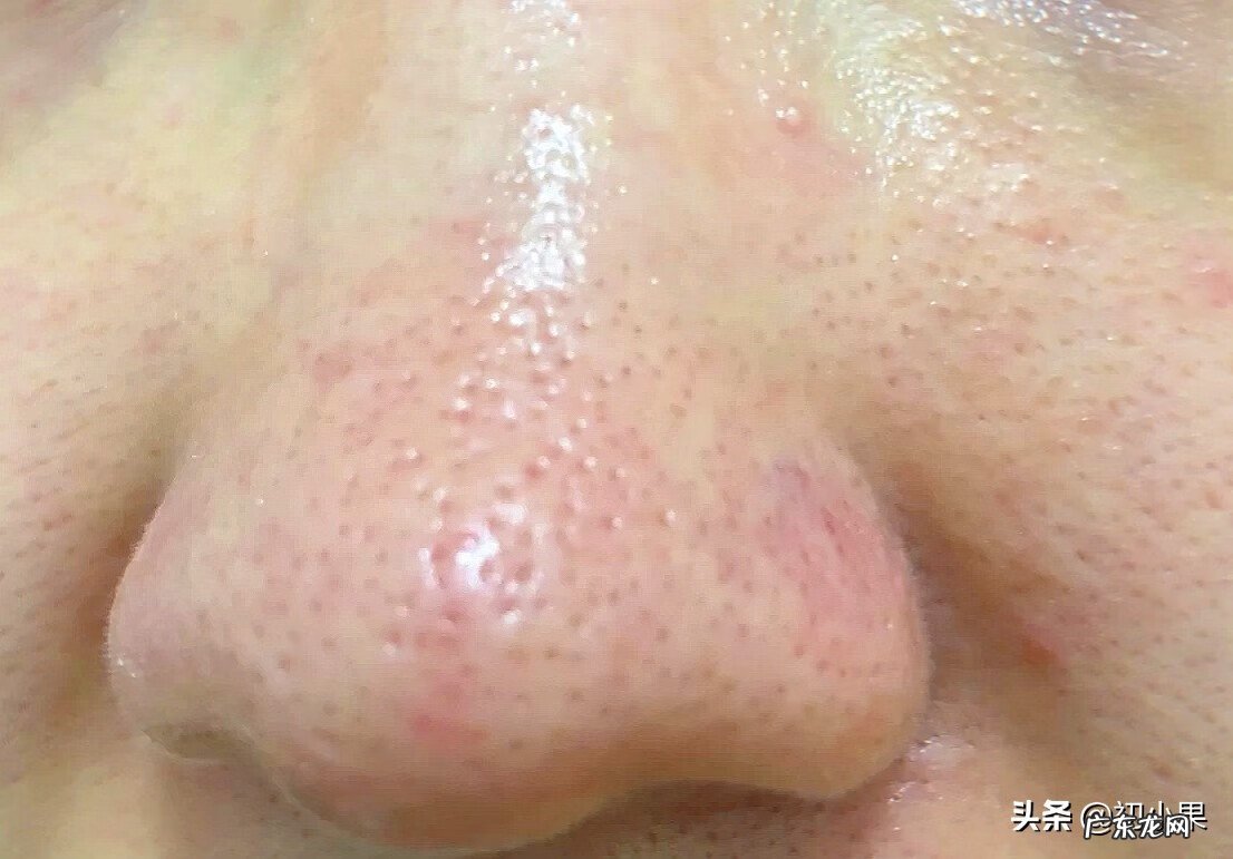 鼻子上的黑头怎么能彻底去掉 如何去鼻子黑头?