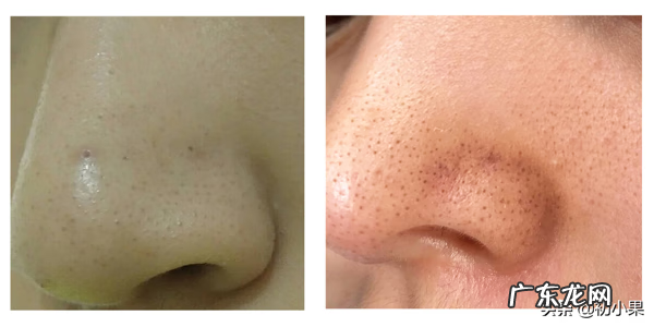 鼻子上的黑头怎么能彻底去掉 如何去鼻子黑头?