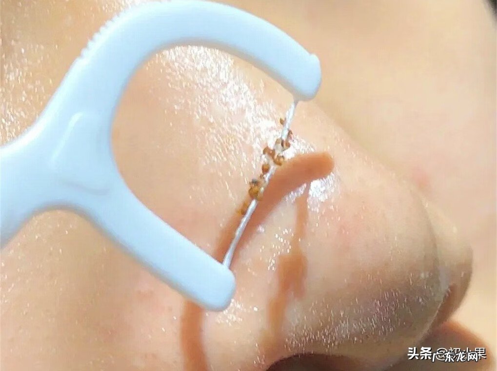 鼻子上的黑头怎么能彻底去掉 如何去鼻子黑头?