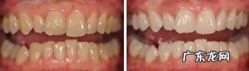 洁白牙齿一般多少钱 陶瓷美白牙齿多少钱