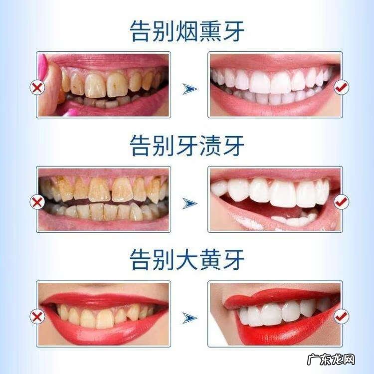 洁白牙齿一般多少钱 陶瓷美白牙齿多少钱