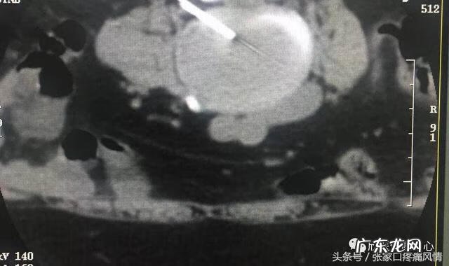 腰间盘突出治疗最好的办法 腰间盘突出治疗方法怎么做