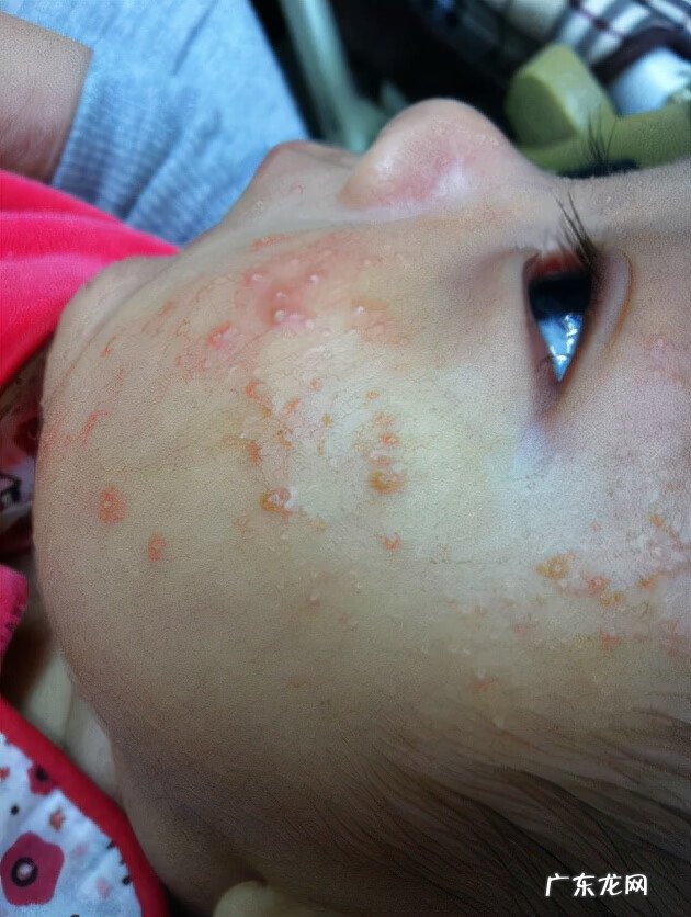 急性湿疹怎么治疗 请问湿疹怎么治疗啊