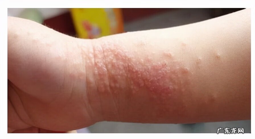 急性湿疹怎么治疗 请问湿疹怎么治疗啊