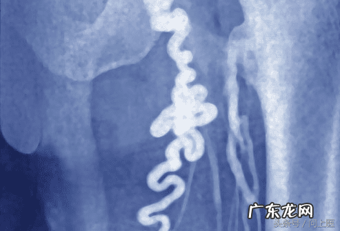 下腹盆腔坠痛 盆腔坠痛恶心