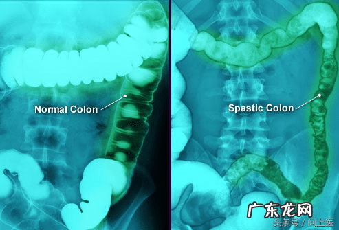 下腹盆腔坠痛 盆腔坠痛恶心