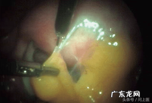 下腹盆腔坠痛 盆腔坠痛恶心