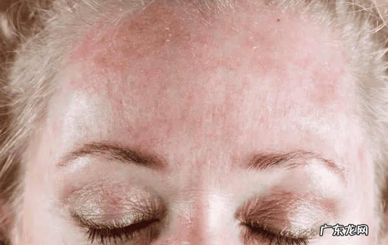 如何快速去掉脸上红血丝 怎样可以去除脸上红血丝