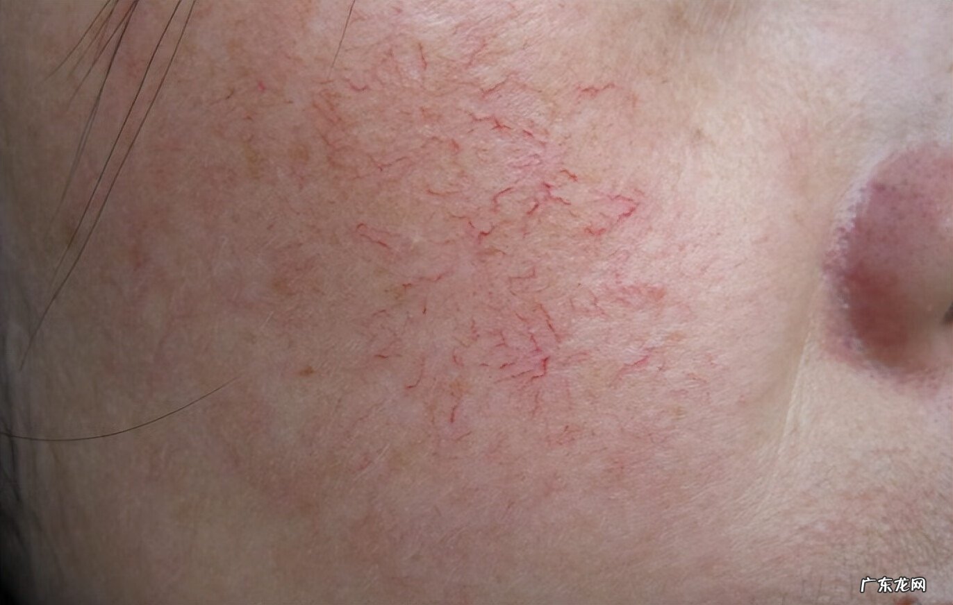 如何快速去掉脸上红血丝 怎样可以去除脸上红血丝