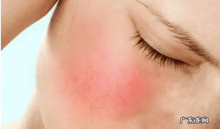 如何快速去掉脸上红血丝 怎样可以去除脸上红血丝