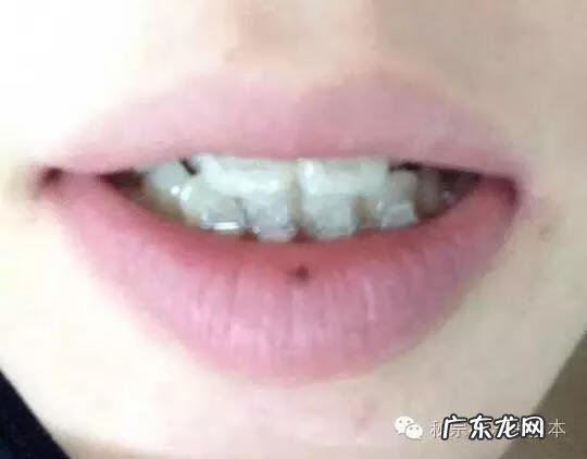 嘴角的痣点掉了还会影响运气吗 嘴唇上的痣风水