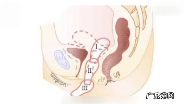 子宫脱垂能跳广场舞吗 跳广场舞掉出子宫 新闻