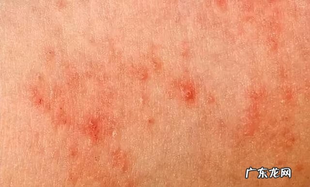 什么是接触性皮炎症状 接触性皮炎的症状表现