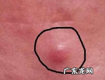 脸上长痘痘印怎么消除 痘印怎么去除最有效的方法