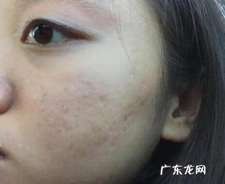 脸上长痘痘印怎么消除 痘印怎么去除最有效的方法
