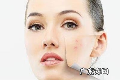 脸上长痘痘印怎么消除 痘印怎么去除最有效的方法