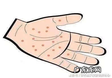 人感染疥螨图片 阴囊疥疮感染图片