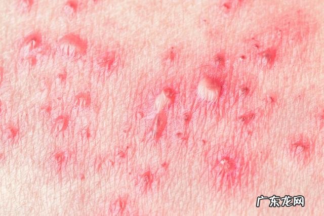 怎么样确认是生殖疱疹图片 生殖疱疹症状图片