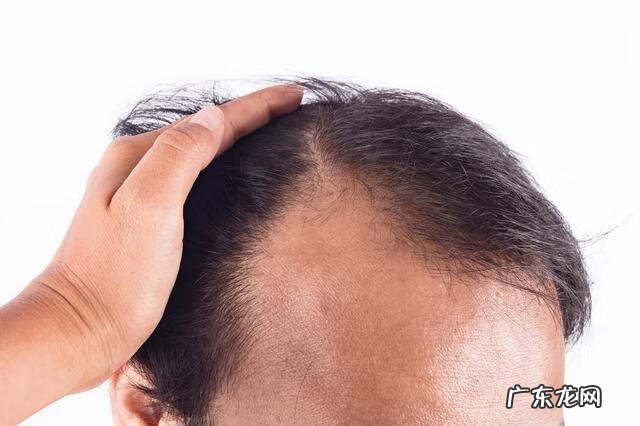 男人秃顶是什么原因 男人秃顶的原因