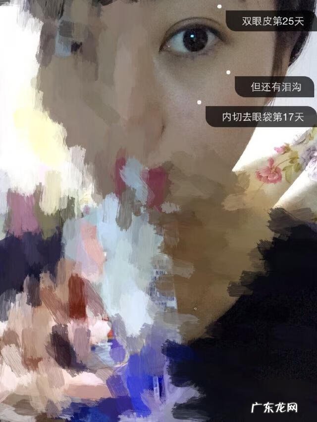 双眼皮埋线效果 埋线双眼皮好么