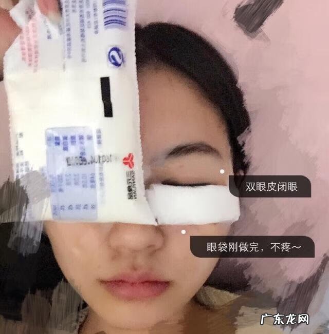 双眼皮埋线效果 埋线双眼皮好么