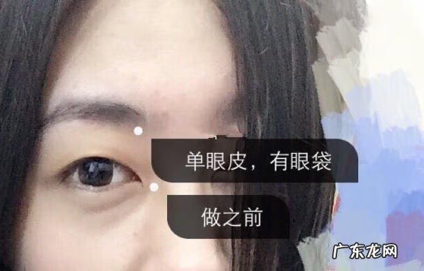 双眼皮埋线效果 埋线双眼皮好么