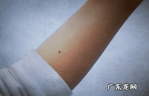 胳膊上痣的位置与命运图 胳膊长痣风水学