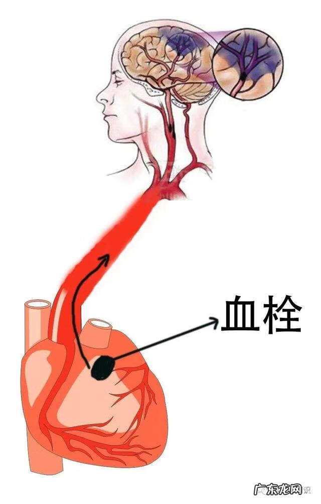 房颤自愈的最佳方式 心房颤动是什么意思