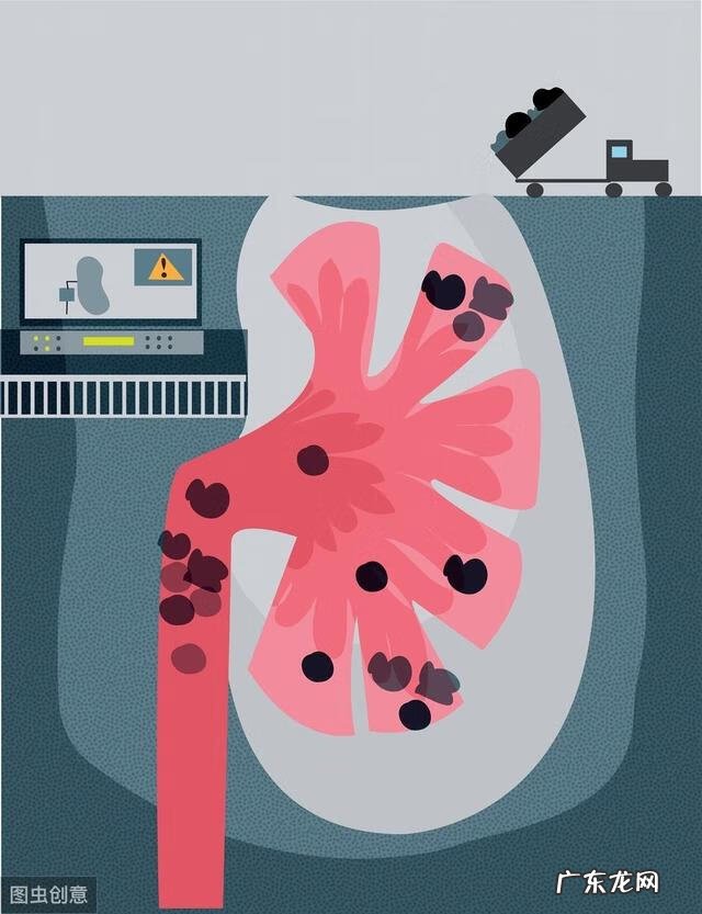 肾结石的治疗原则 肾结石的治疗方法有几种