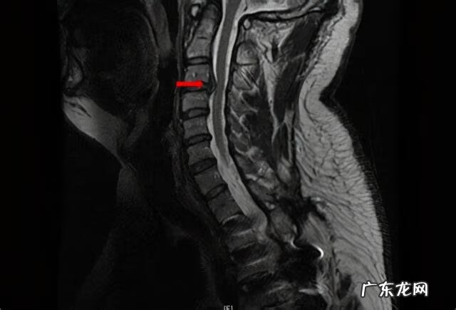 手指一阵一阵的发麻 手指头发麻是什么情况