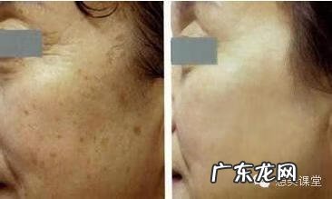 儿童雀斑怎么去除方法 怎样祛除雀斑