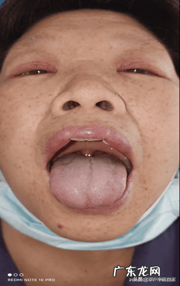 风水相搏西医叫什么 水肿风水相搏证的水肿特点是