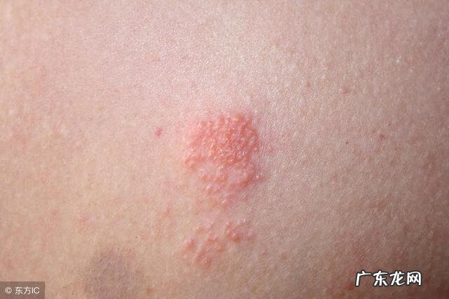 长小水泡是什么原因引起的 长水泡的原因是什么