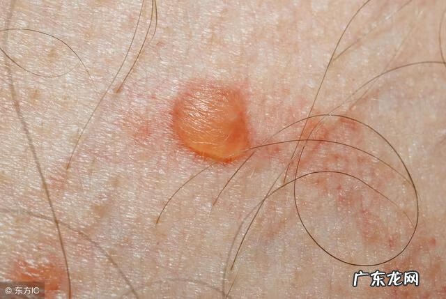 长小水泡是什么原因引起的 长水泡的原因是什么