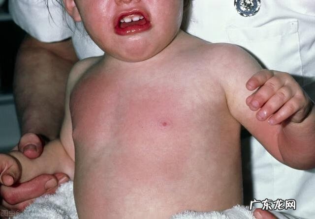 烫伤后恢复得快的窍门 严重烫伤后如何处理