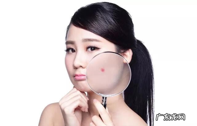 痤疮解决方法 治疗痤疮的简单方法