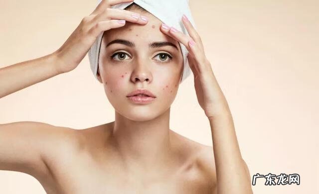 痤疮解决方法 治疗痤疮的简单方法