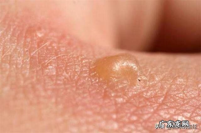 女人艾滋病最明显特征 女人艾滋病的三大症状图片大全