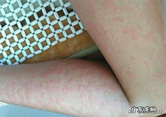 女人艾滋病最明显特征 女人艾滋病的三大症状图片大全