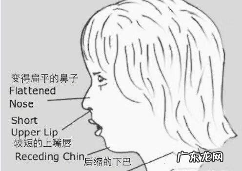 下颌后缩原因 下颌后缩是如何造成的