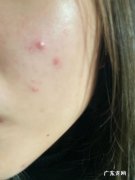 怎样治疗青春痘 如何有效去除青春痘
