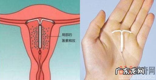 节育环图片大全片 型号 节育环的图片大全