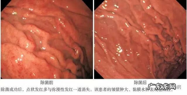 慢性浅表性胃炎怎么治 慢性浅表性胃炎是什么意思