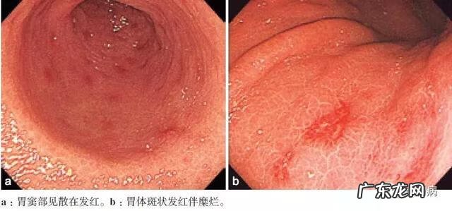 慢性浅表性胃炎怎么治 慢性浅表性胃炎是什么意思