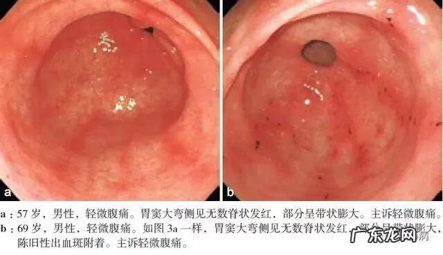 慢性浅表性胃炎怎么治 慢性浅表性胃炎是什么意思