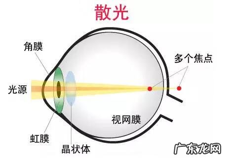 眼睛散光是什么情况 眼睛散光是怎么回事