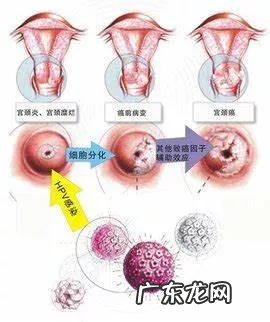 宫颈癌筛查太疼了 宫颈筛查注意事项