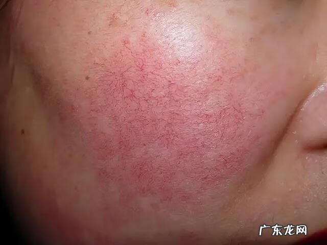 脸上血丝怎么去掉 如何去掉脸上的红血丝