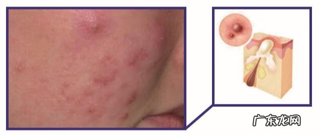 脸上长痤疮的图片 脸部痤疮图片