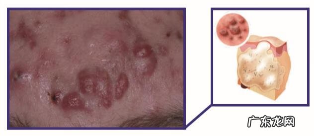 脸上长痤疮的图片 脸部痤疮图片